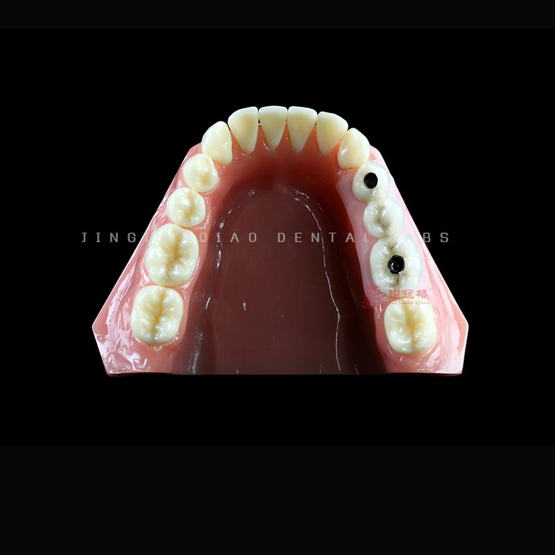 All on Dental Implants with Zircornia Abutment Dental Implant Titanium Bridges and Screwed Crowns