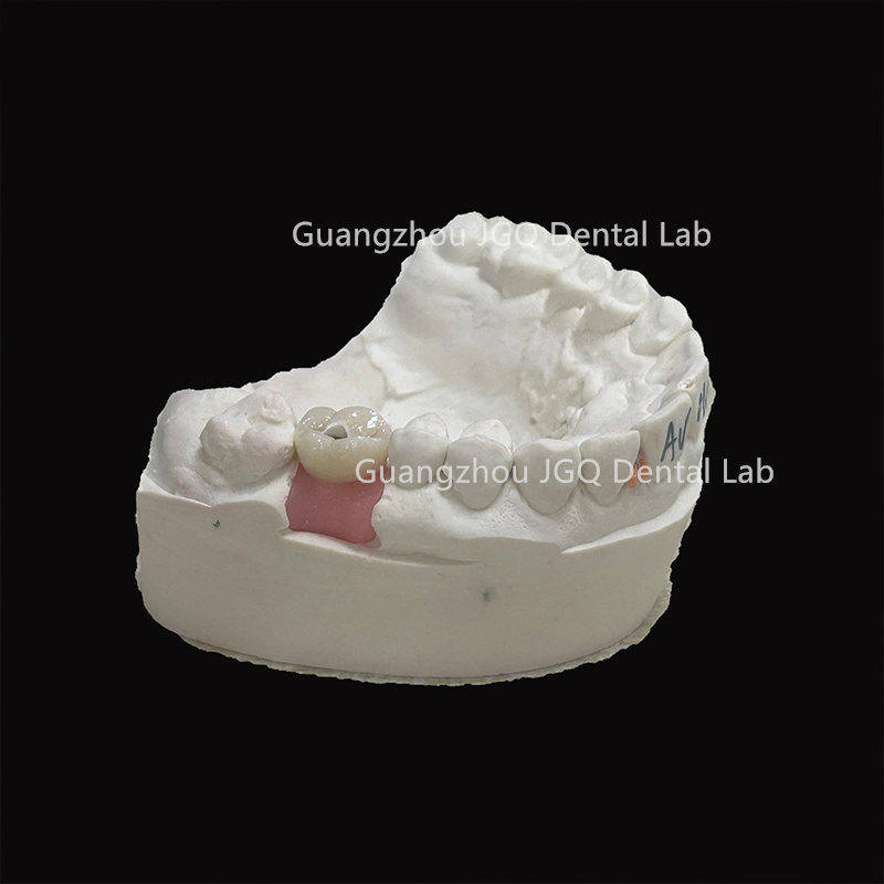 Dental Implant Zirconia Crown and Titanium Abutment Competitive Price Dental Lab Manufacture