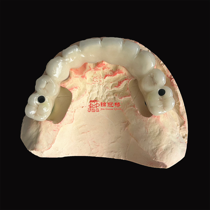 Dental Implants Cutomized Titanium Abutment with Pfm Bridges Restore Natural Bite Force and Chewing Function