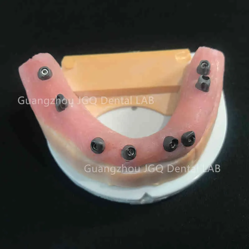Implant Dentures