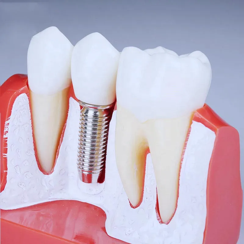 Titanium Dental Implant