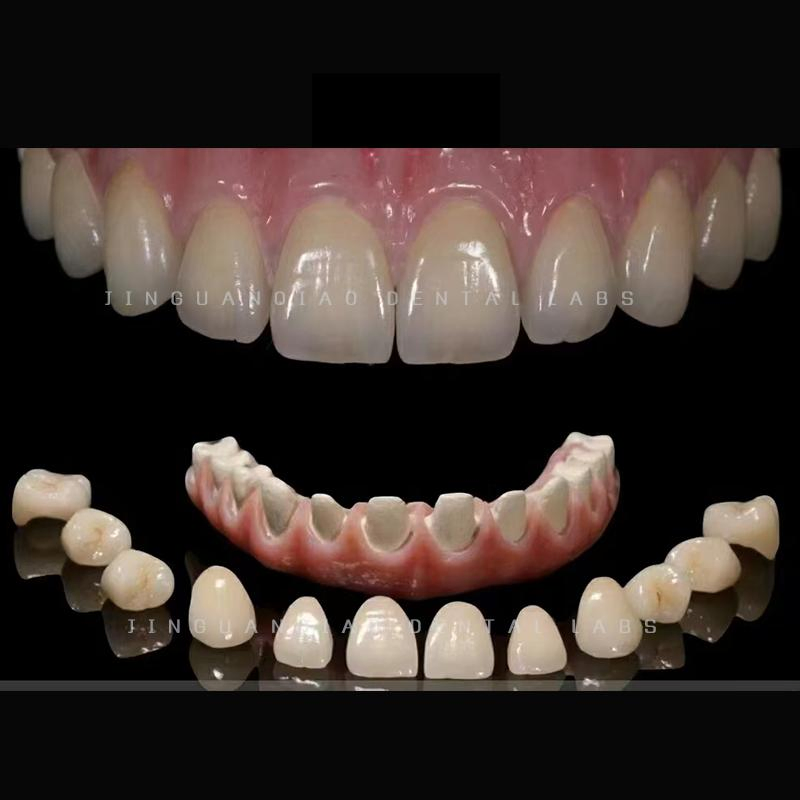 Dental Implant Hybrid Dentures with Titanium Bridge and Screwed Zircornia Crowns Lab China