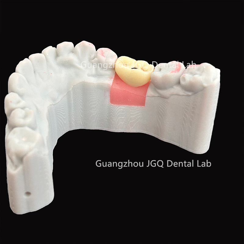 Dental Implant Zirconia Crown and Titanium Abutment Competitive Price Dental Lab Manufacture