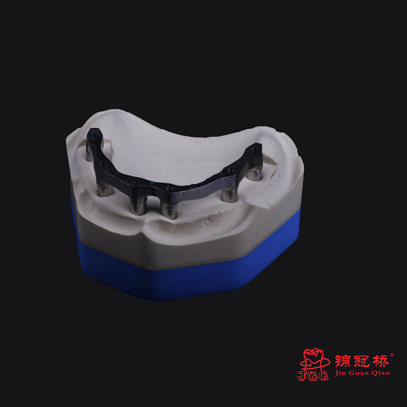 3D Digital Titanium Framework for Dental Implant Supported