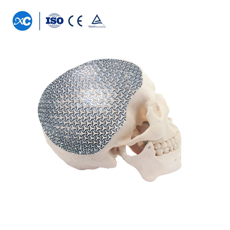 Neurosurgery Skull Mesh Cranial Skull Restoration System Anatomical 3D Titanium Mesh