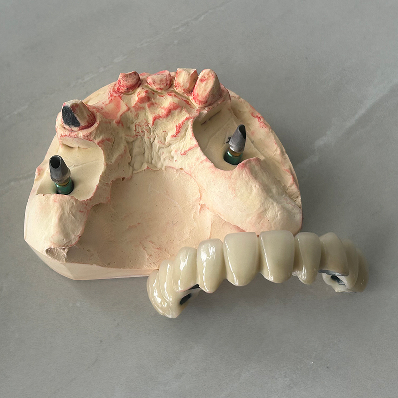 Dental Implants Cutomized Titanium Abutment with Pfm Bridges Restore Natural Bite Force and Chewing Function