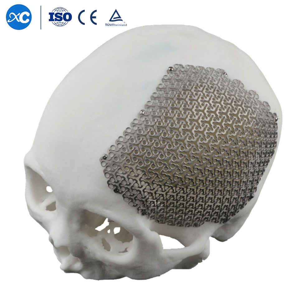 Neurosurgery Skull Mesh Cranial Skull Restoration System Anatomical 3D Titanium Mesh