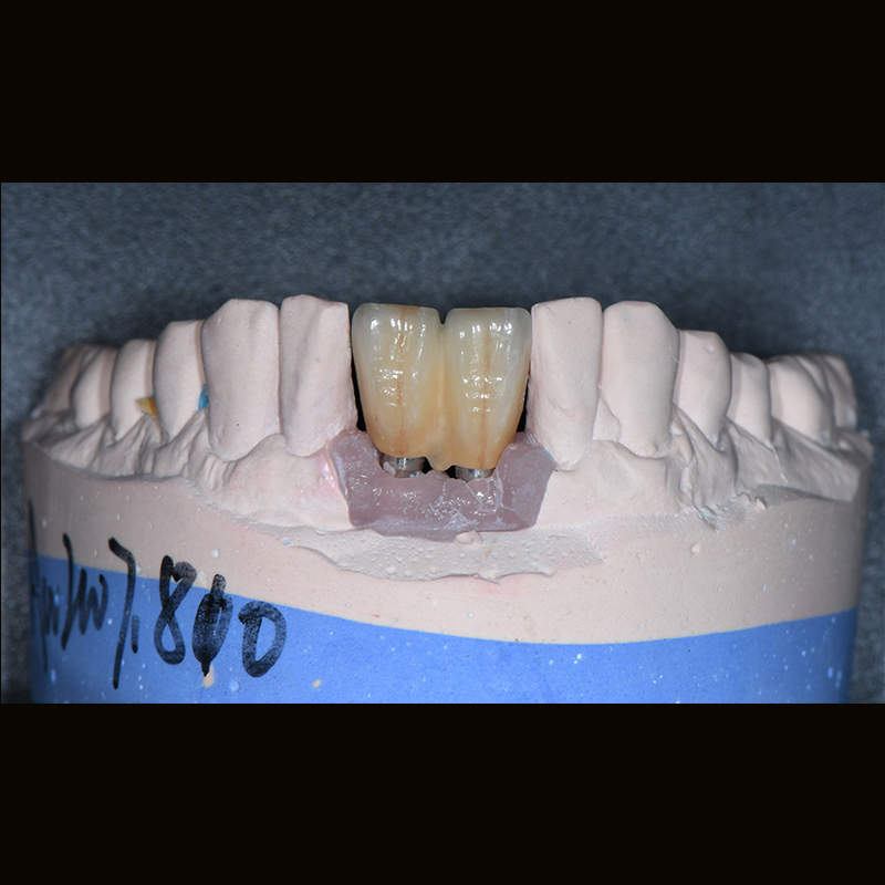 Dental Lab China Custom Implant Front Zirconia Teeth Titanium Abutment 3 Days in Lab