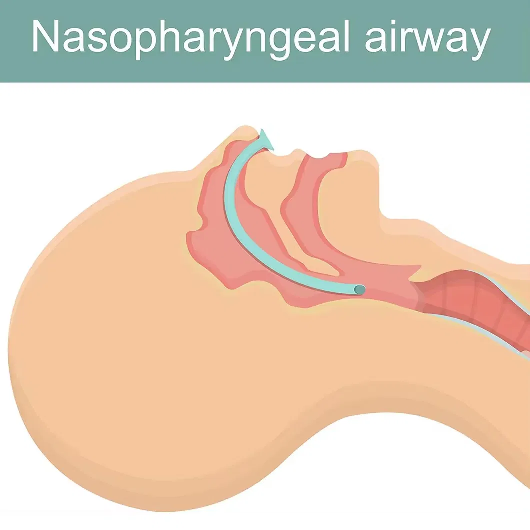 Nasopharyngeal Airway Features