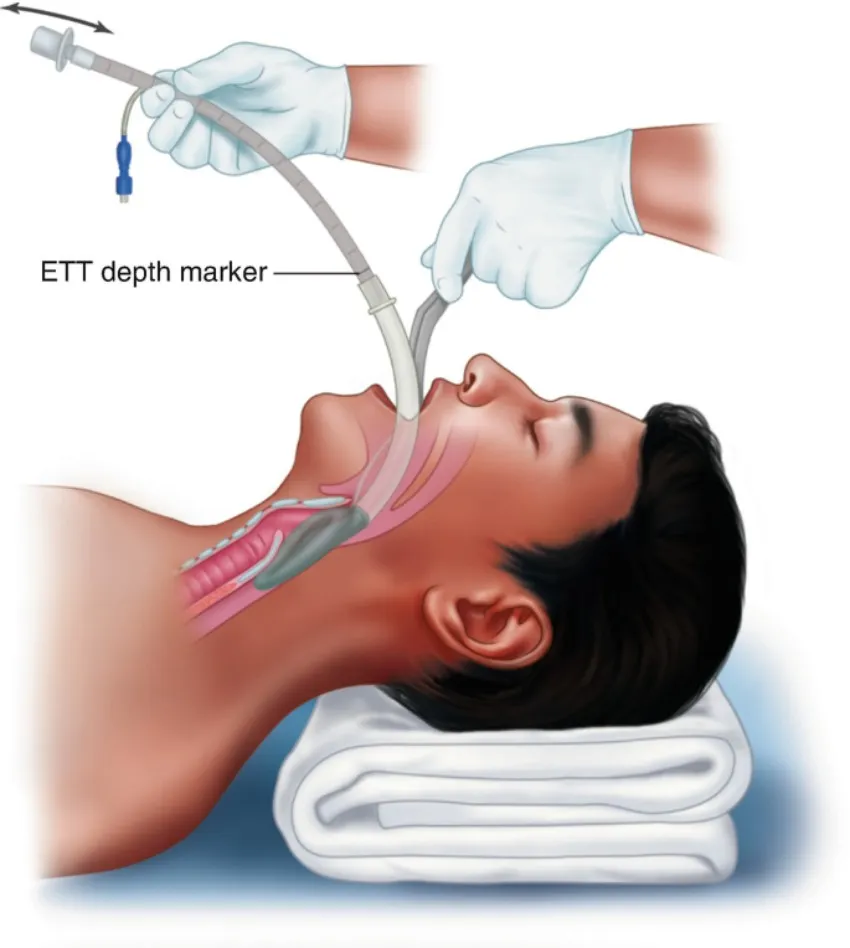 Guided Intubation Device