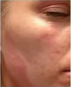 Dry Skin