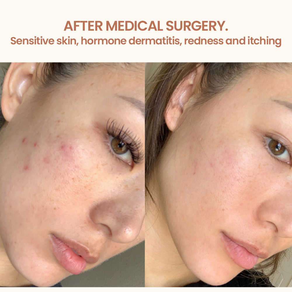 Anti-Allergy Sensitive Skin Care Products Private Label Organic Repair Redness Face Facial Serum Moisturizer Cream Skincare Set