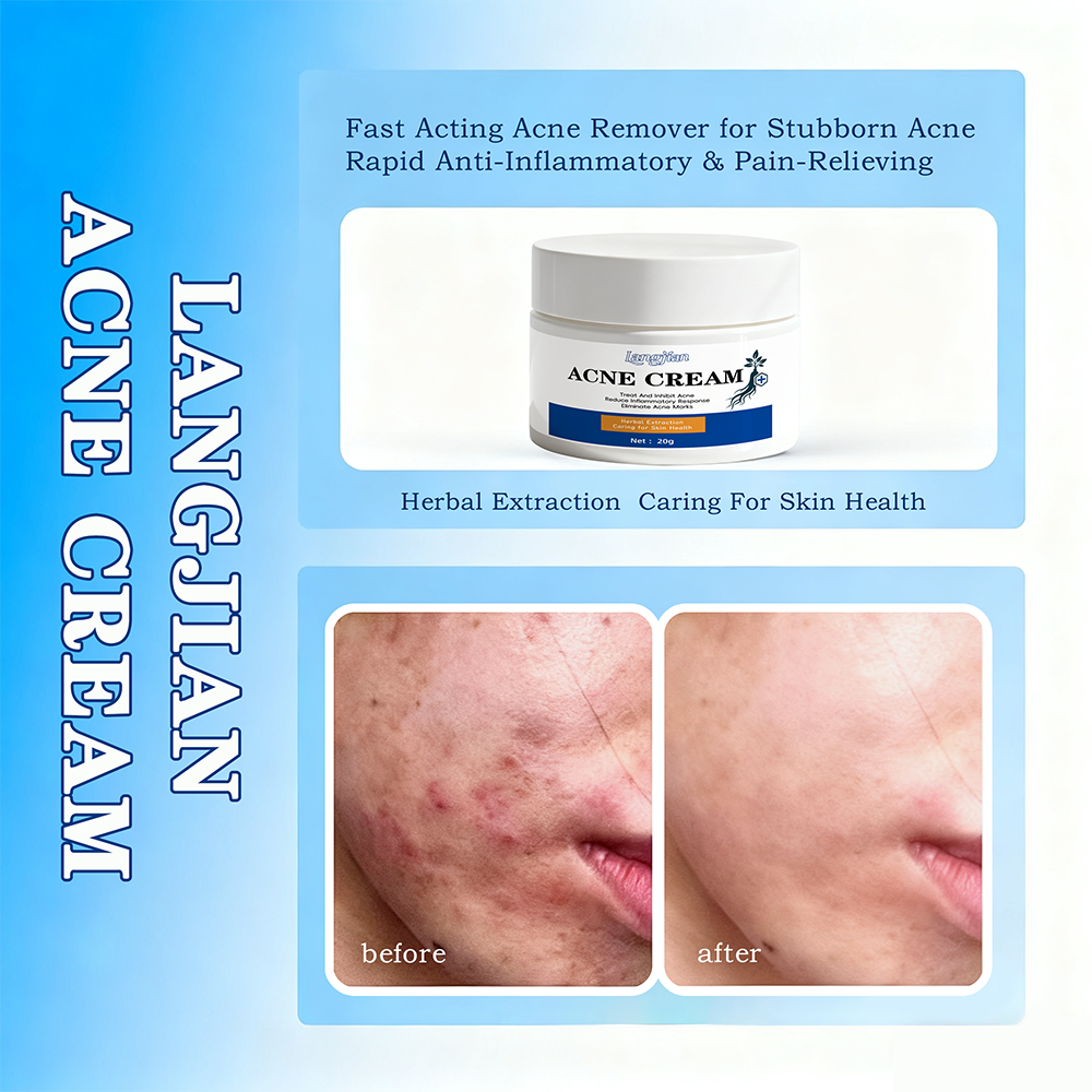 Natural Plant-Based Acne Cream Herbal Tea Extracts Fragrant Botanical Blend Visible Pimple Reduction Anti-Wrinkle Rejuvenating