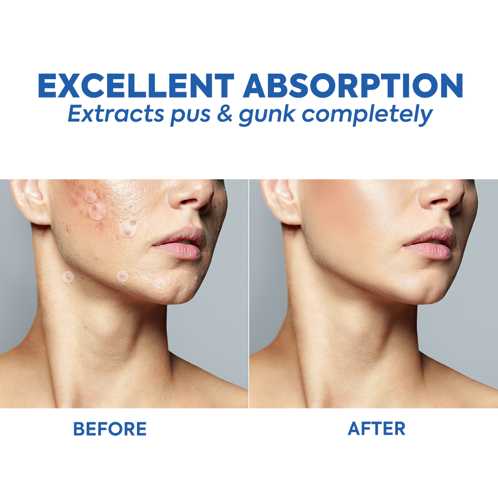 New Item OEM Waterproof Hydrocolloid Pimple Acne Patches Acne Pimple Cover Patch For Acne Treatment