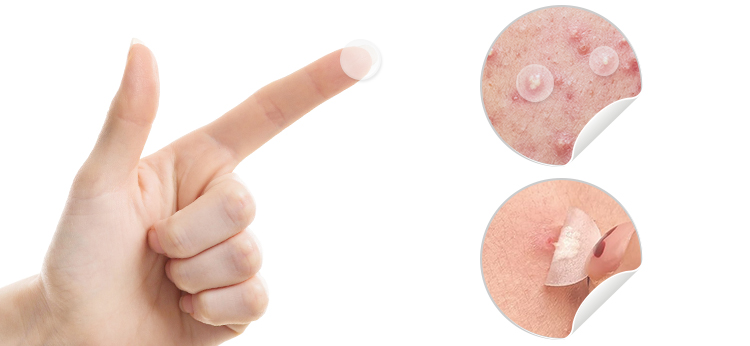 Acne Patch Feature 2