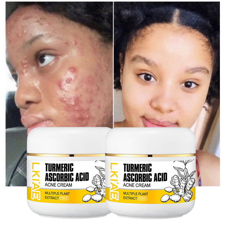 Natural Ingredients With Niacinamide 50ml Curcuma Reduce Dark Spots Lightening Face Cream Lotion Gel for Hyperpigmentation