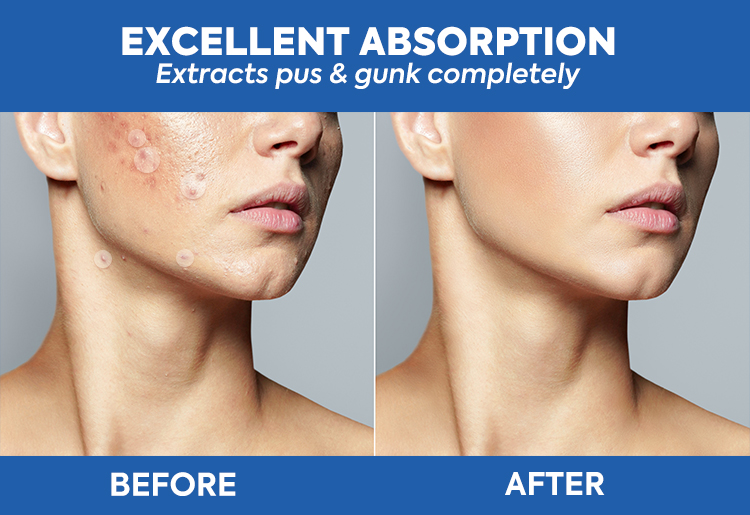 Acne Patch Feature 5