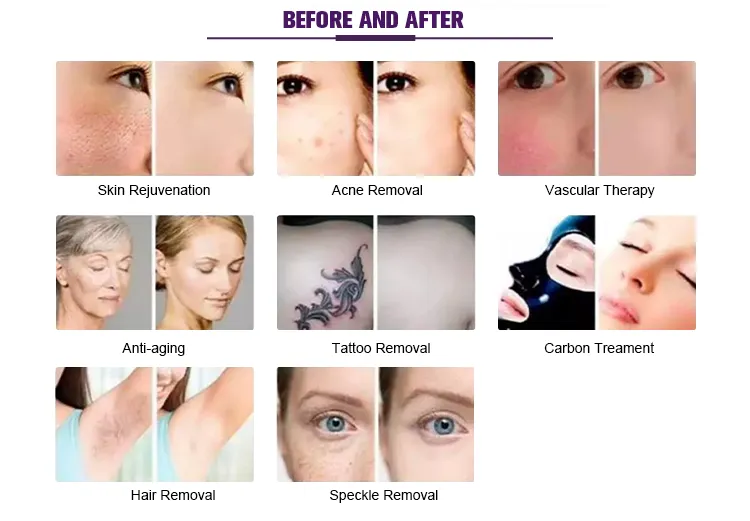 Professional E Light Skin Rejuvenation Machine High Quality IPL Depilator Hair Removal Device
