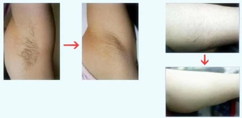 Home Use Mini Epilator IPL Permanent Hair Removal Beauty Device