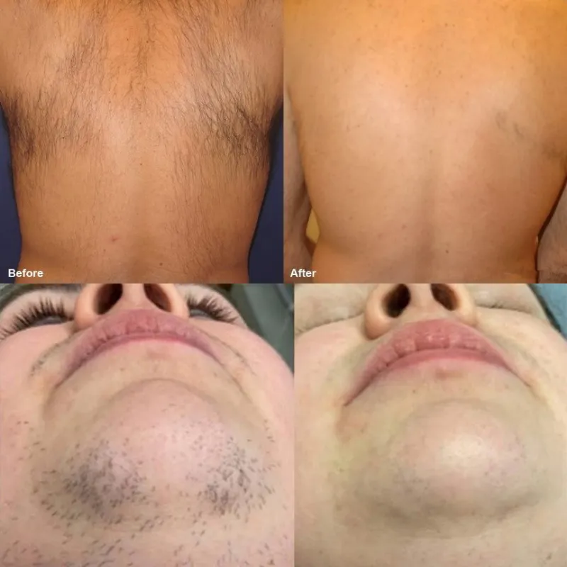 808nm 755nm 1064nm Diode Laser Hair Removal and Skin Rejuvenation Beauty Device for Clinic Use