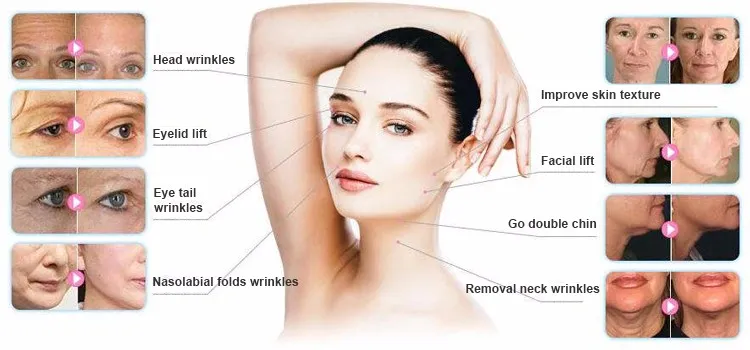 Portable 3D 4D Hifu Beauty Device for Face and Body Anti-Aging Breast Lift Cellulite Treatment