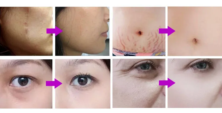 Portable Electric Mini Water Meso Smart Injector Pen Nano Mesotherapy Microneedle Derma Pen Beauty Device