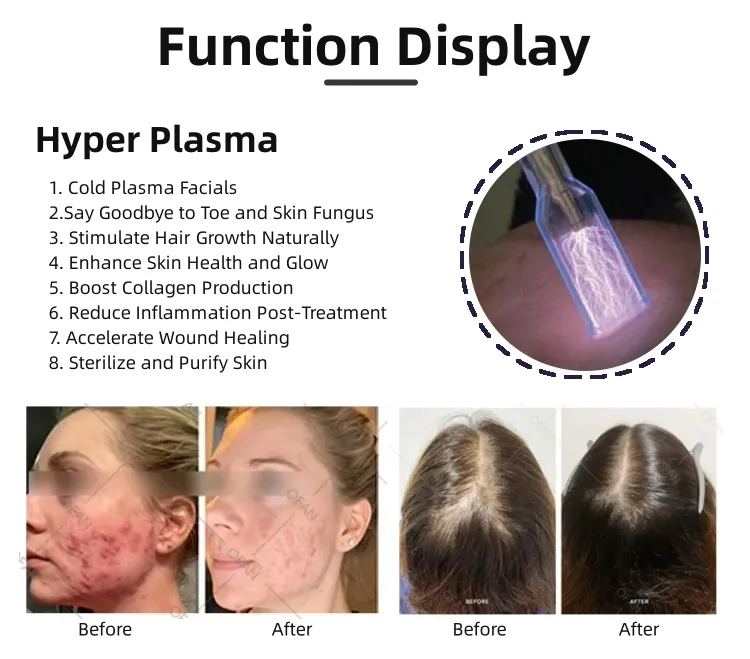 Portable Acne Scars Removal Cold Plasma Treatment Facial Lifting Cold Jet Plasma Cold Plasma Beauty Device