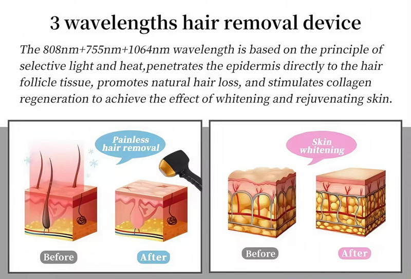 Three-band Hair Removal Device Whole Body Available Safe and Noninvasive Skin Rejuvenation and Firming Improves Skin Texture