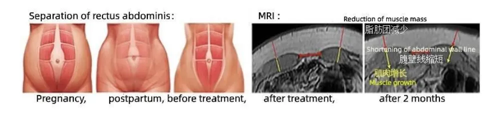 Professional Body Contouring Device for Muscle Building and Fat Loss