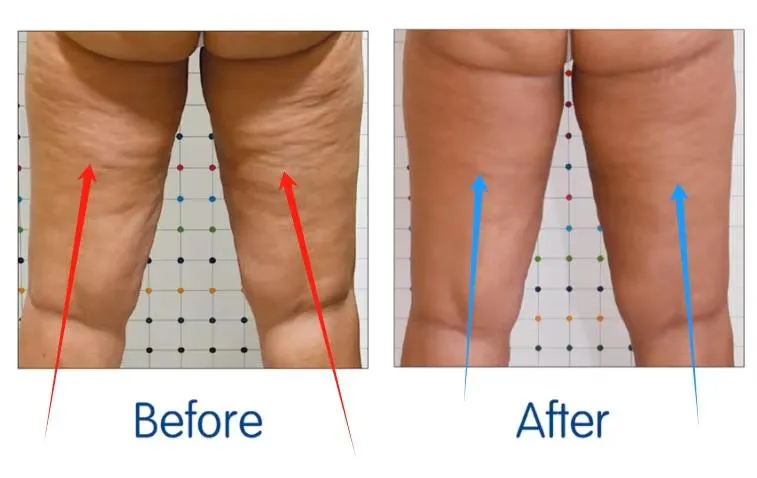 Body Contouring Inbody Cold and Hot Slimming Cellulite Onda Coolwaves Device