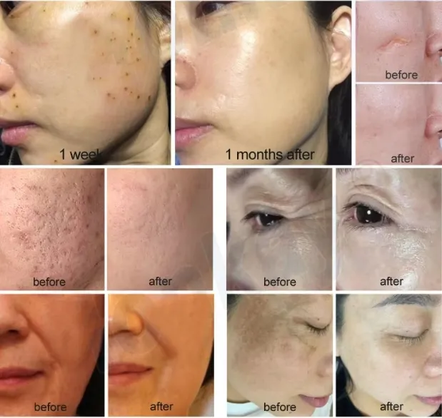 Cold Plasma Face Treatment Before and After