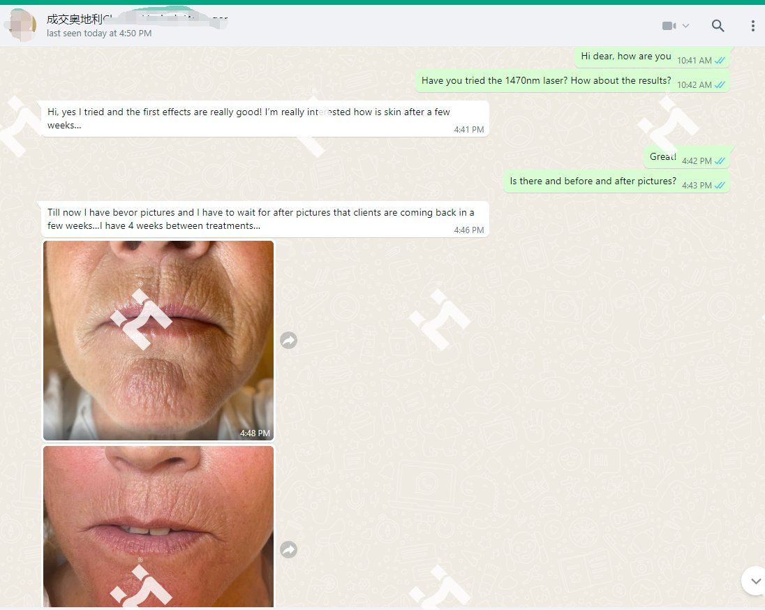 Salon Use Face Lift Skin Rejuvenation 1470nm Laser Wrinkle Removal Face Lift Device From Factory