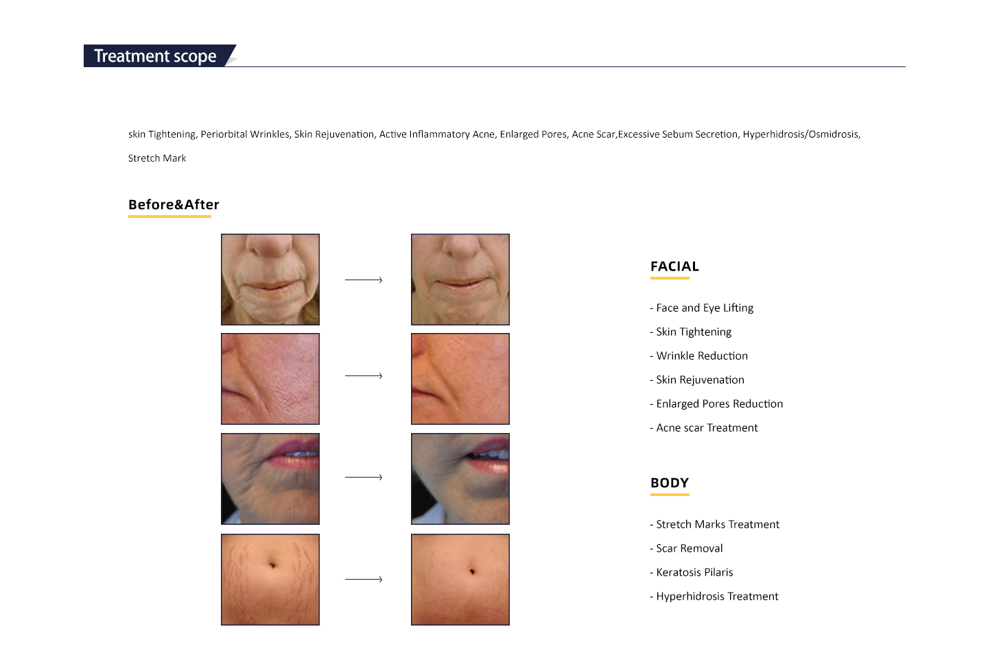 RF Therapy Handles