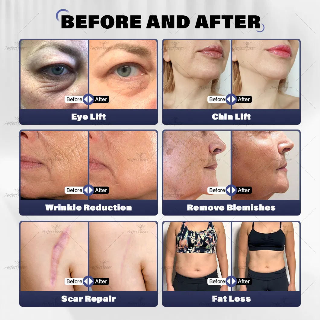 Popular Body Contouring 12D Hifu Wrinkle Remove RF Skin Tightening Beauty Device