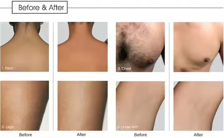 2026 New Arrival Diode Laser Hair Removal Device Skin Rejuvenation Beauty Salon Device