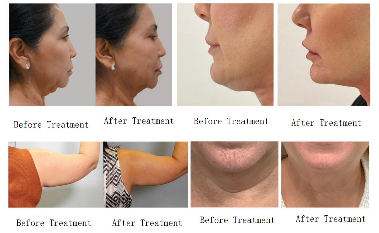 Before and After Results 1