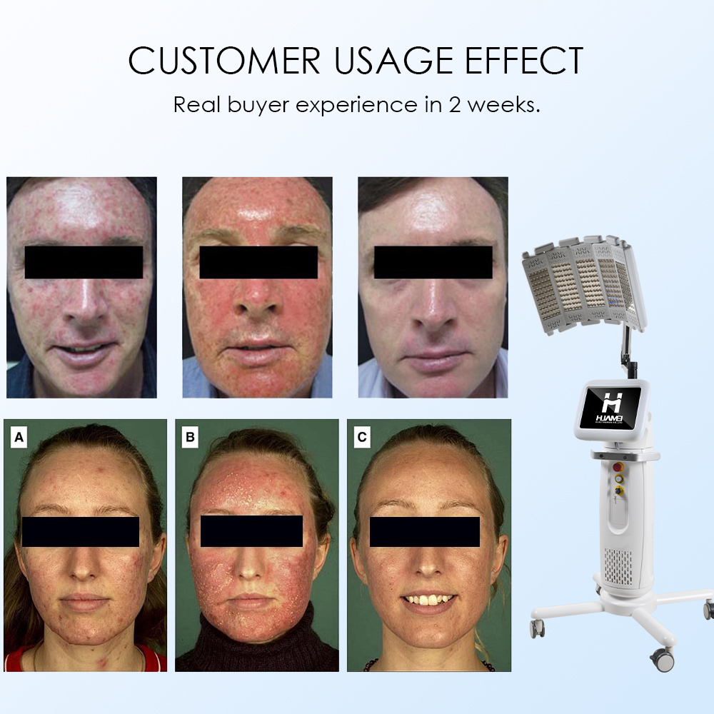 New Arrival Red and Blue Light Therapy PDT Machine Skin Rejuvenation Light Facial Pdt Led Light Therapy Machine