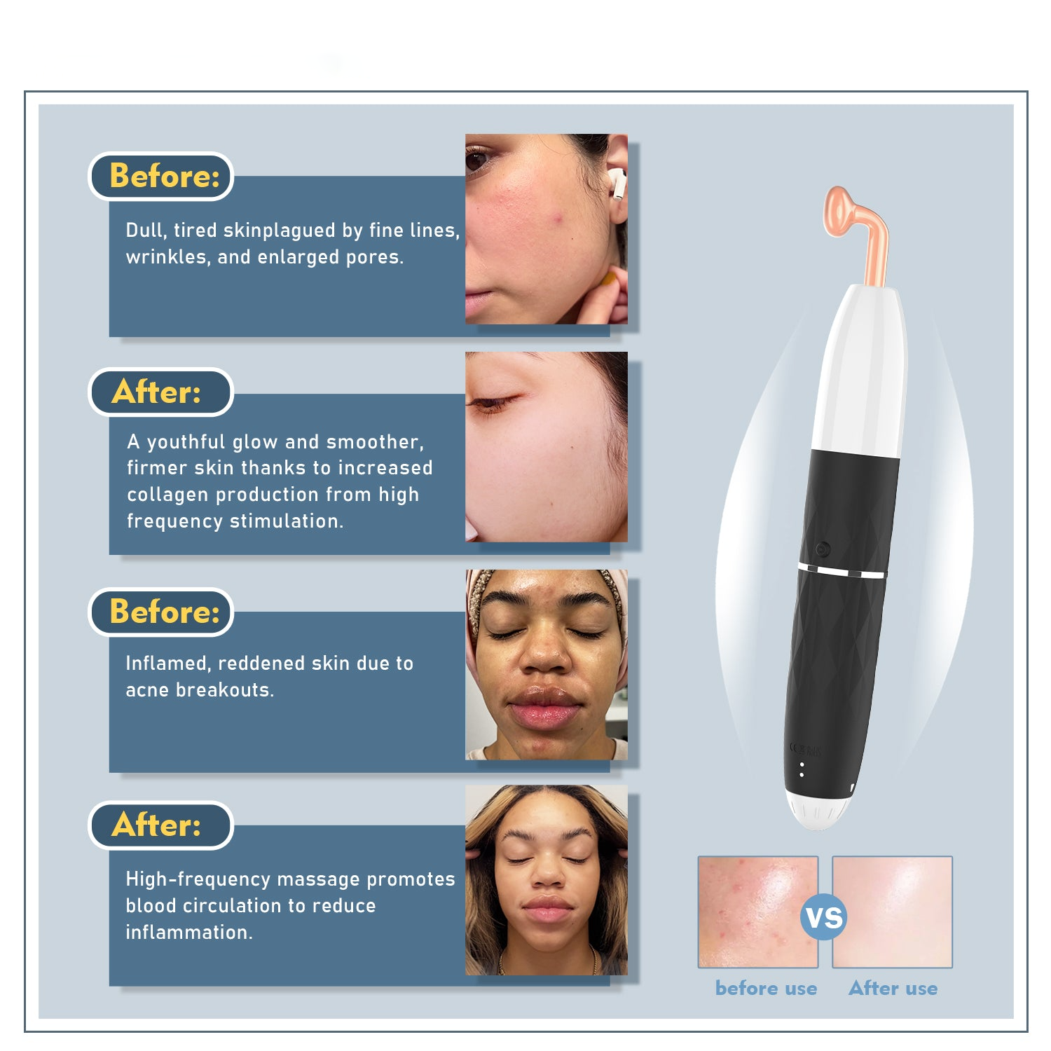 High-Frequency Rechargeable Acne Treatment Face Lifting Machine with Radio Frequency Technology