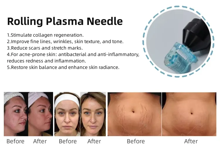 Portable Acne Scars Removal Cold Plasma Treatment Facial Lifting Cold Jet Plasma Cold Plasma Beauty Device