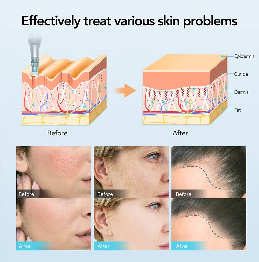Professional Microneedling Device for Skin Renewal and Rejuvenation