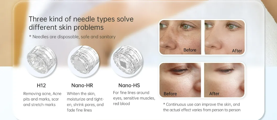 Advanced IPL Acne Treatment Device for Professional Skin Care