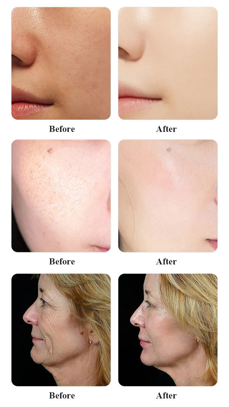 Before and After Results of Face Lifting Device