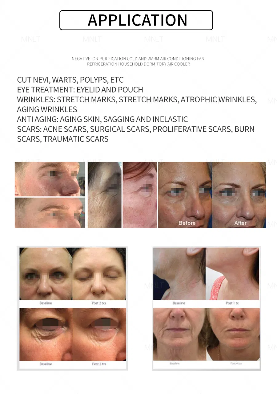 Lifting Skin Rejuvenation Results