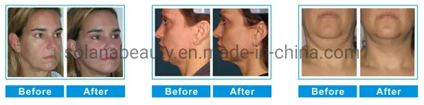 Professional 5 Cartridges Hifu Maquina Facelift Body Slimming Beauty Device