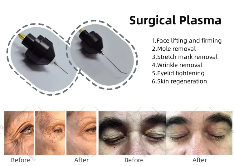 Portable Acne Scars Removal Cold Plasma Treatment Facial Lifting Cold Jet Plasma Cold Plasma Beauty Device