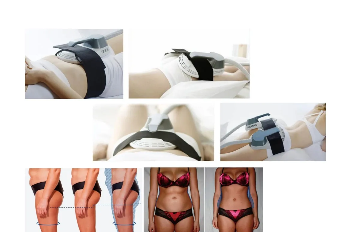 EMS Body Sculpting clinic results