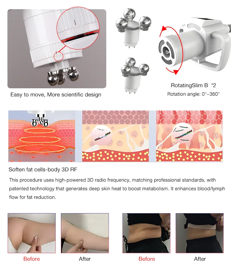 Advanced RF Skin Tightening Device Treatment Advantages