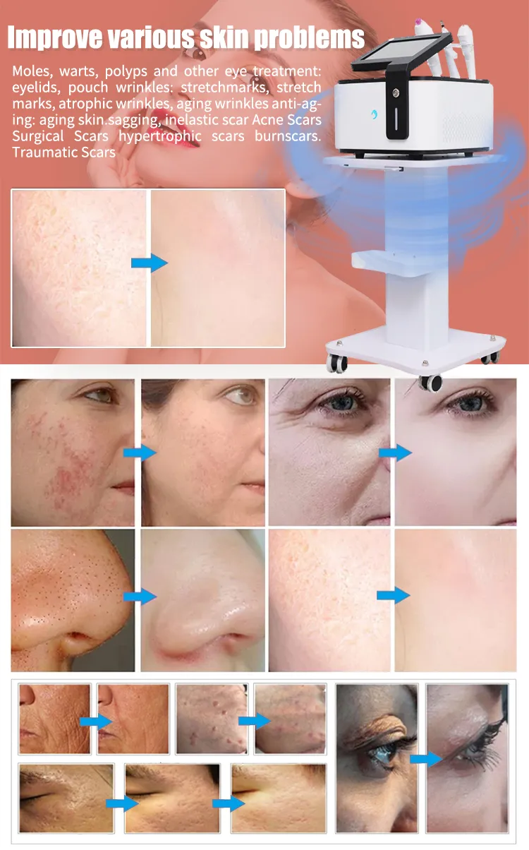 Advanced Fractional Cold Plasma Facial Treatment Device for Beauty