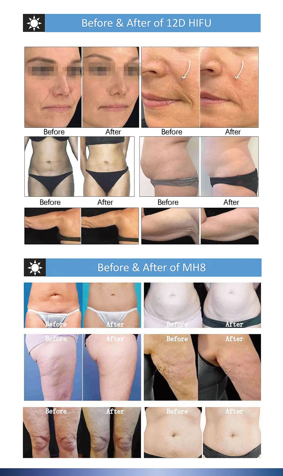 Portable Hifu Device for Skin Tightening & Body Contouring Treatments