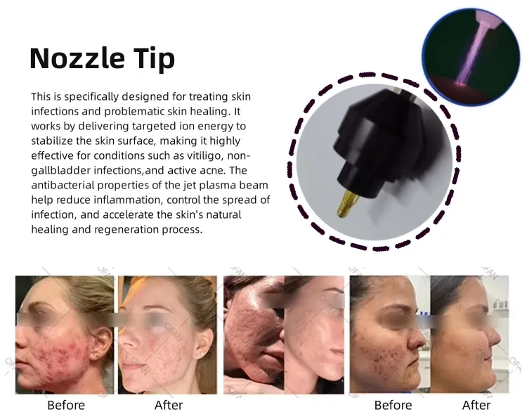 Portable Acne Scars Removal Cold Plasma Treatment Facial Lifting Cold Jet Plasma Cold Plasma Beauty Device